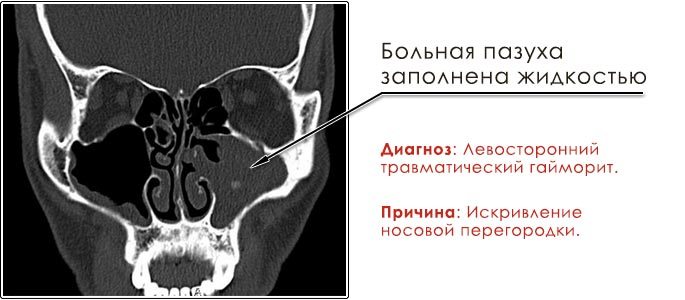 Фото рентген-снимок пазух, диагноз — травматический гайморит