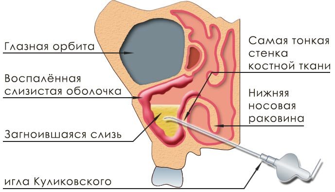 Схема прокола носовой пазухи