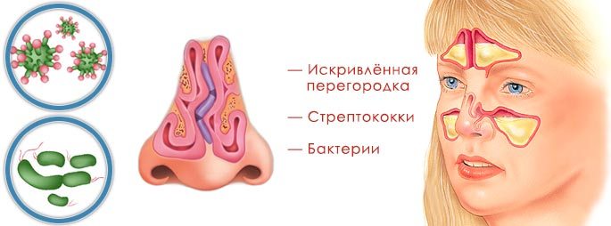 Деформация носовой перегородки, бактерии и стрептококки