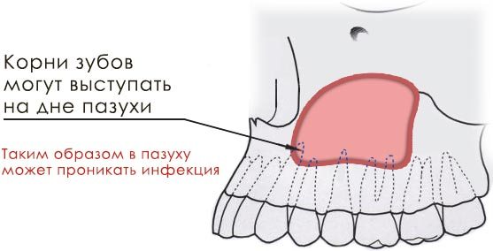 Схема проникновения в пазуху зубных бактерий