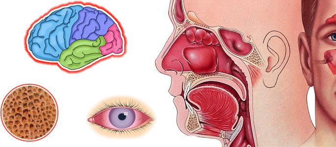 Вероятность осложнений на мозг, глаза и кости