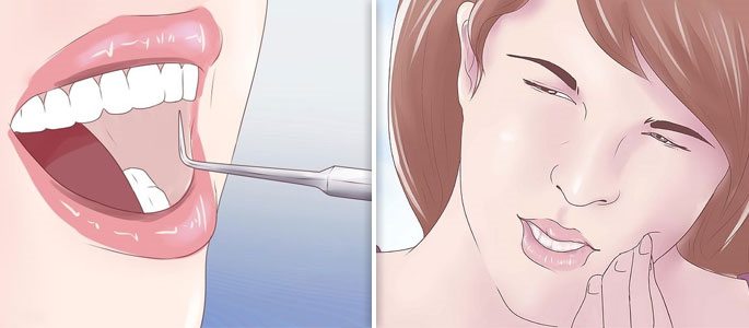 Развитие гайморита от больных зубов