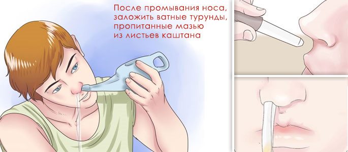 Промывание и закладка в нос ватных тампонов