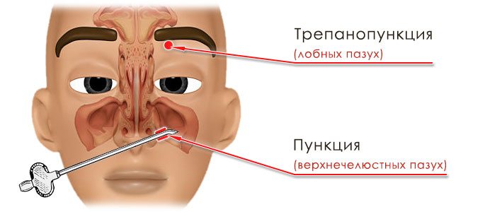 Операции: трепанопункция фронтальных и пункция верхнечелюстных пазух