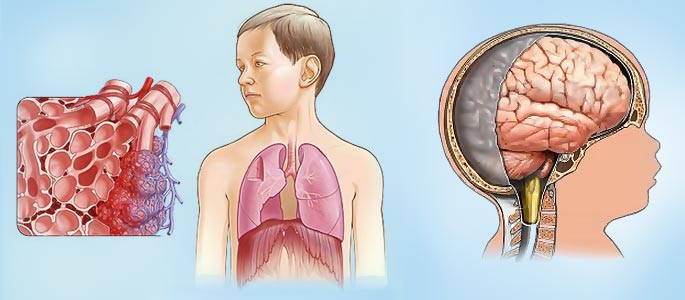 Осложнения фронтита в виде пневмонии и менингита у детей