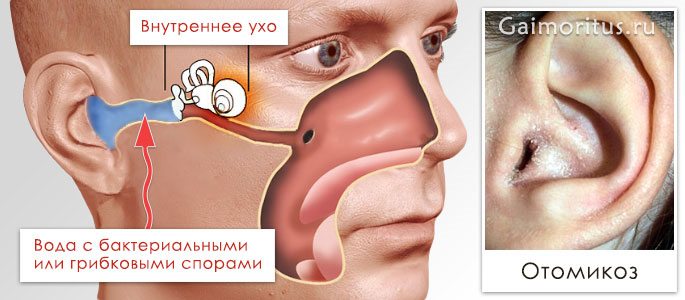 Развитие грибковых шелушений в ушах