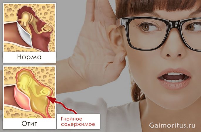 Ухудшение слуха из-за воспаления в ухе