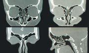Рентгеновские снимки пазух