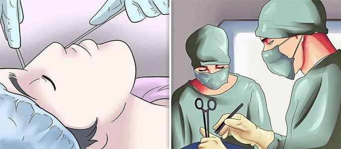 Хирургическая операция в полости носа