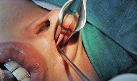 Хирургические операции при гайморите